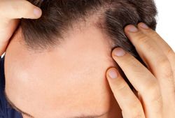 The Risk of “Shock Loss” after Hair Transplants Have Been Placed - Boston MA