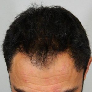 FUT and FUE with PRP or Stem Cells Before and After Pictures Boston, MA
