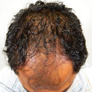 FUT and FUE with PRP or Stem Cells Before and After Pictures Boston, MA