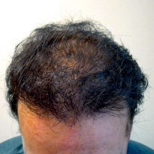 FUT and FUE Procedure Before and After Pictures Boston, MA