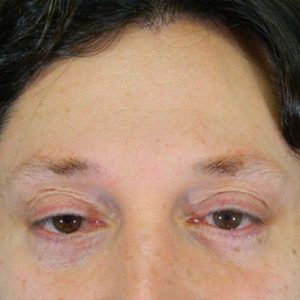 Beard, Eyebrow and Eyelash Restoration Before and After Pictures Boston, MA