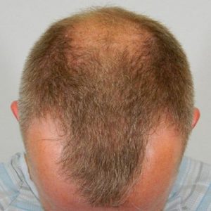 FUT and FUE Procedure Before and After Pictures Boston, MA