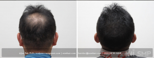 Scalp Micropigmentation Before and After Pictures Boston, MA