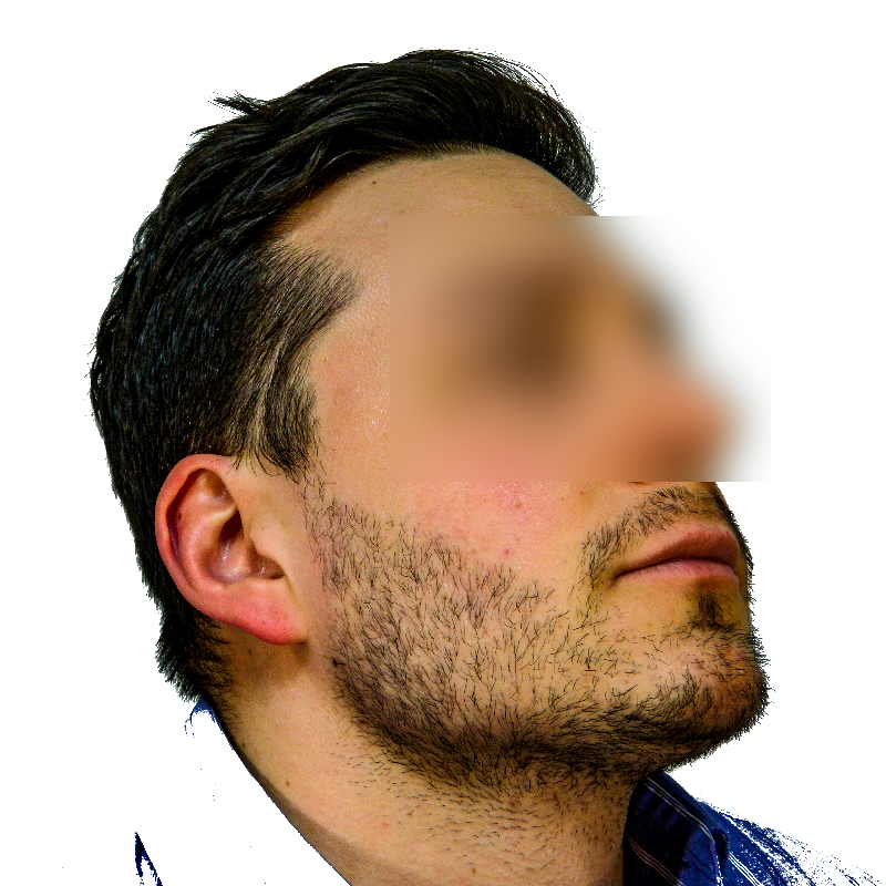 Beard, Eyebrow and Eyelash Restoration Before and After Pictures Boston, MA