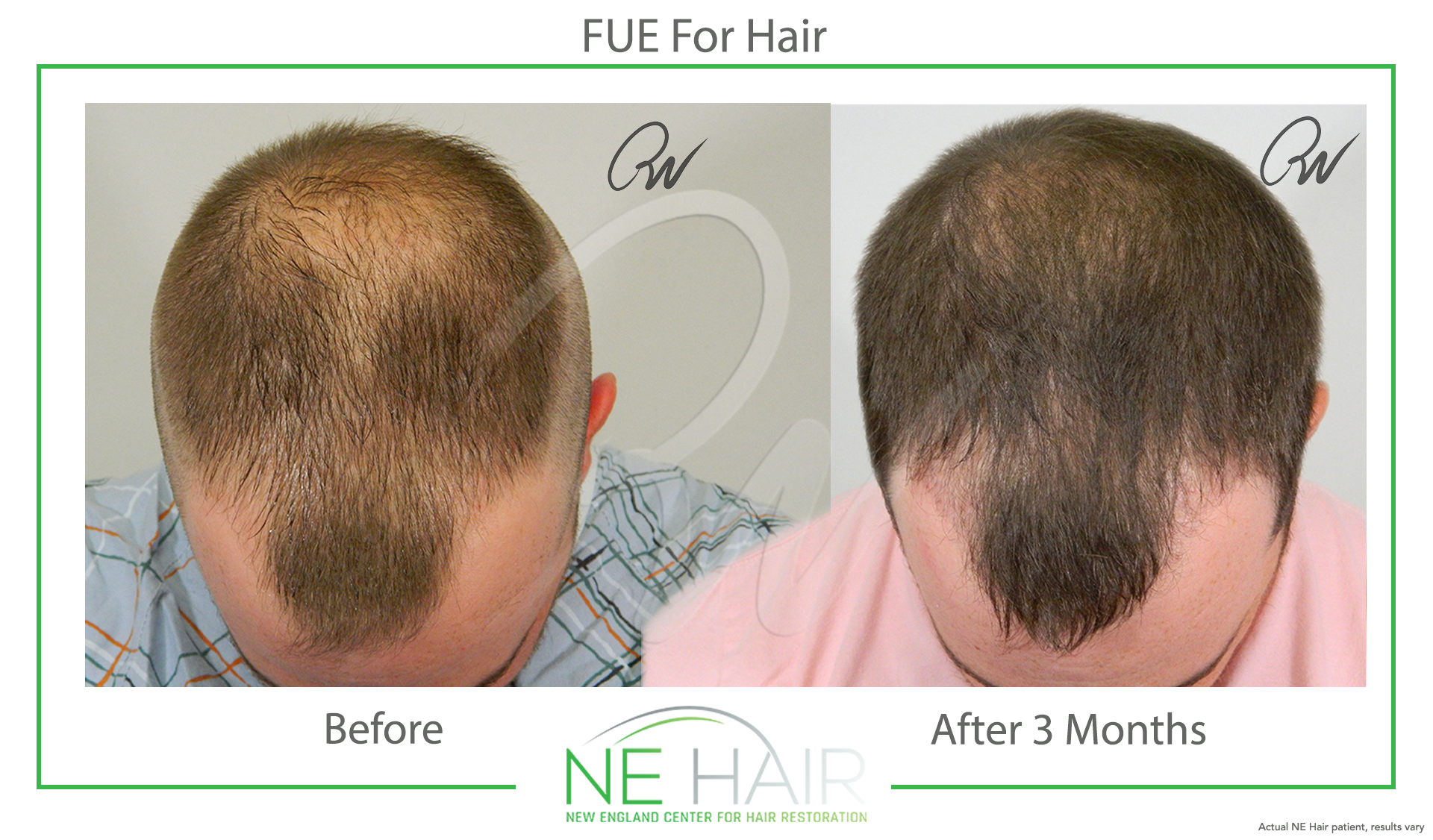 FUE 3 Months Male copy - New England Center for Hair Restoration