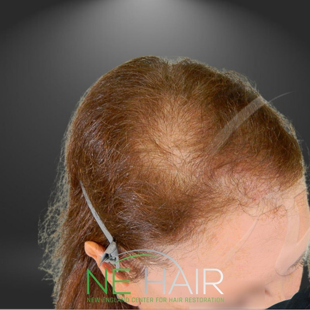 nehair post precedure (48) - New England Center for Hair Restoration