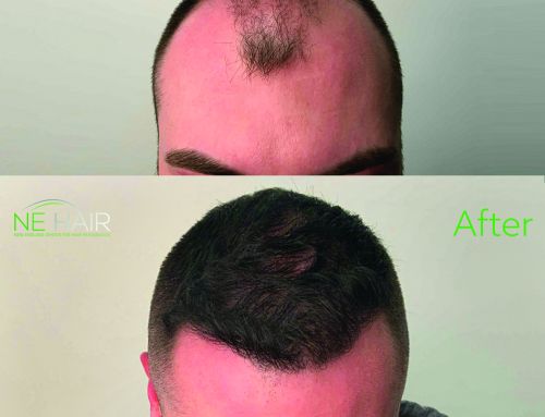 The Complete Guide to Micro FUE Hair Transplants: What You Need to Know