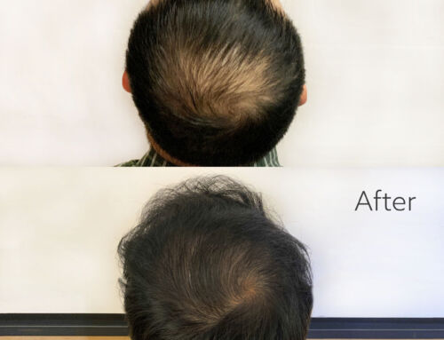 Decoding Micro FUE: A Breakthrough in Hair Restoration