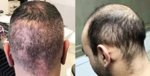 Hair Transplant Turkey