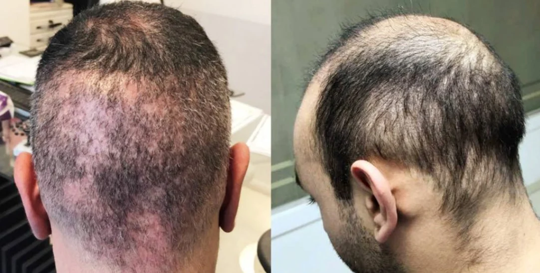 hair-transplant-gone-wrong