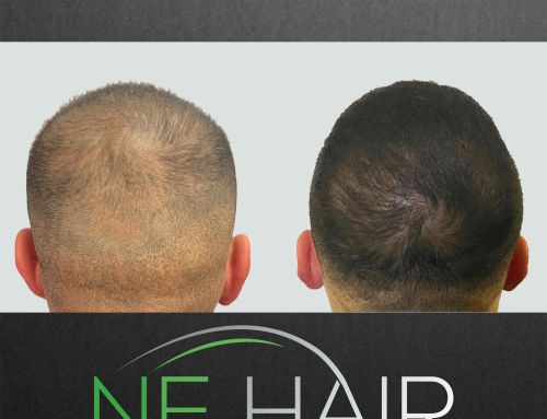 Advantages of Micro FUE Hair Transplants Over Traditional Methods