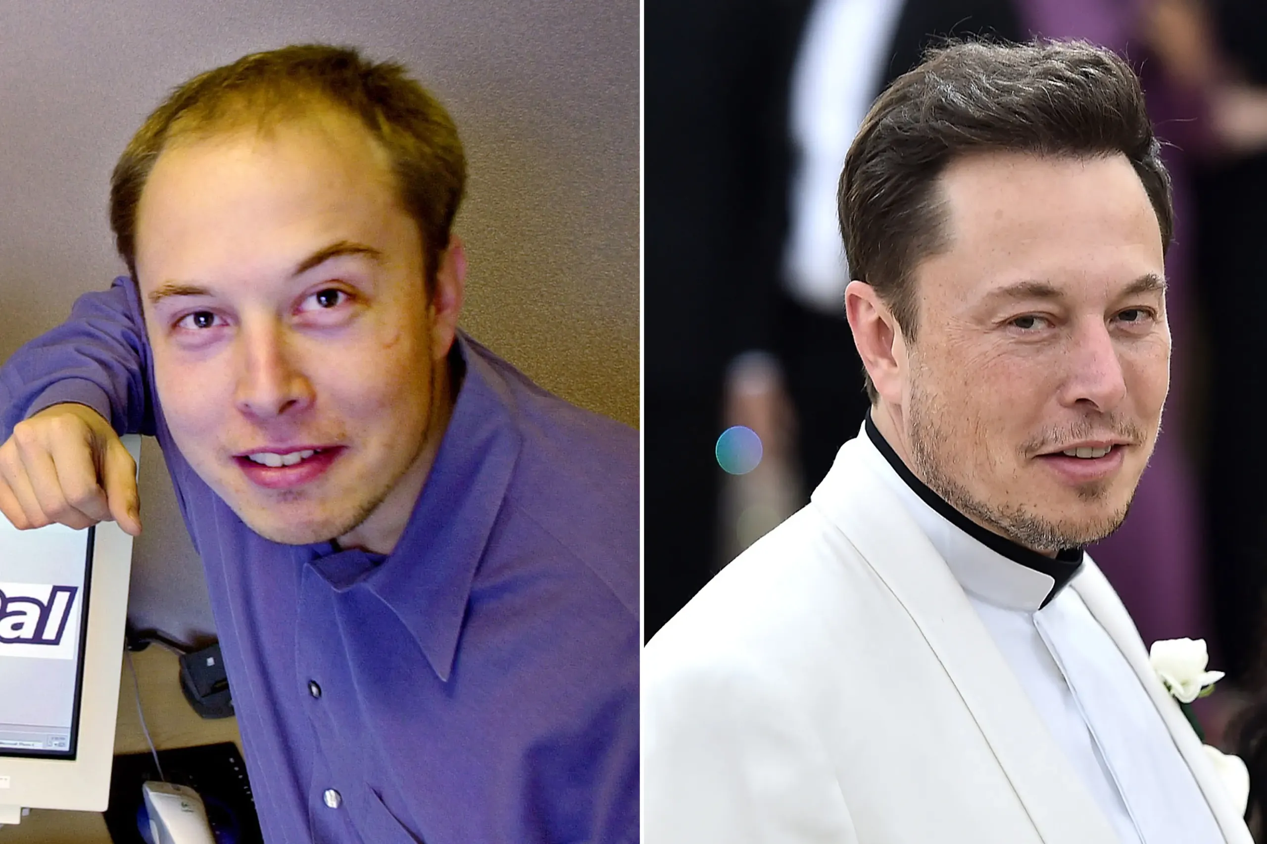 Elon Musk's Hair Transplant | Unveiling His Hair Transformation