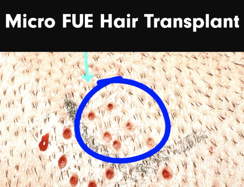 Achieving Natural Results with Micro FUE Hair Transplants