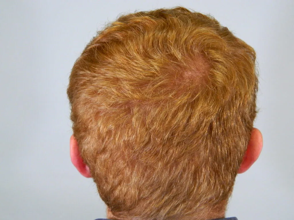 Red Hair Facts