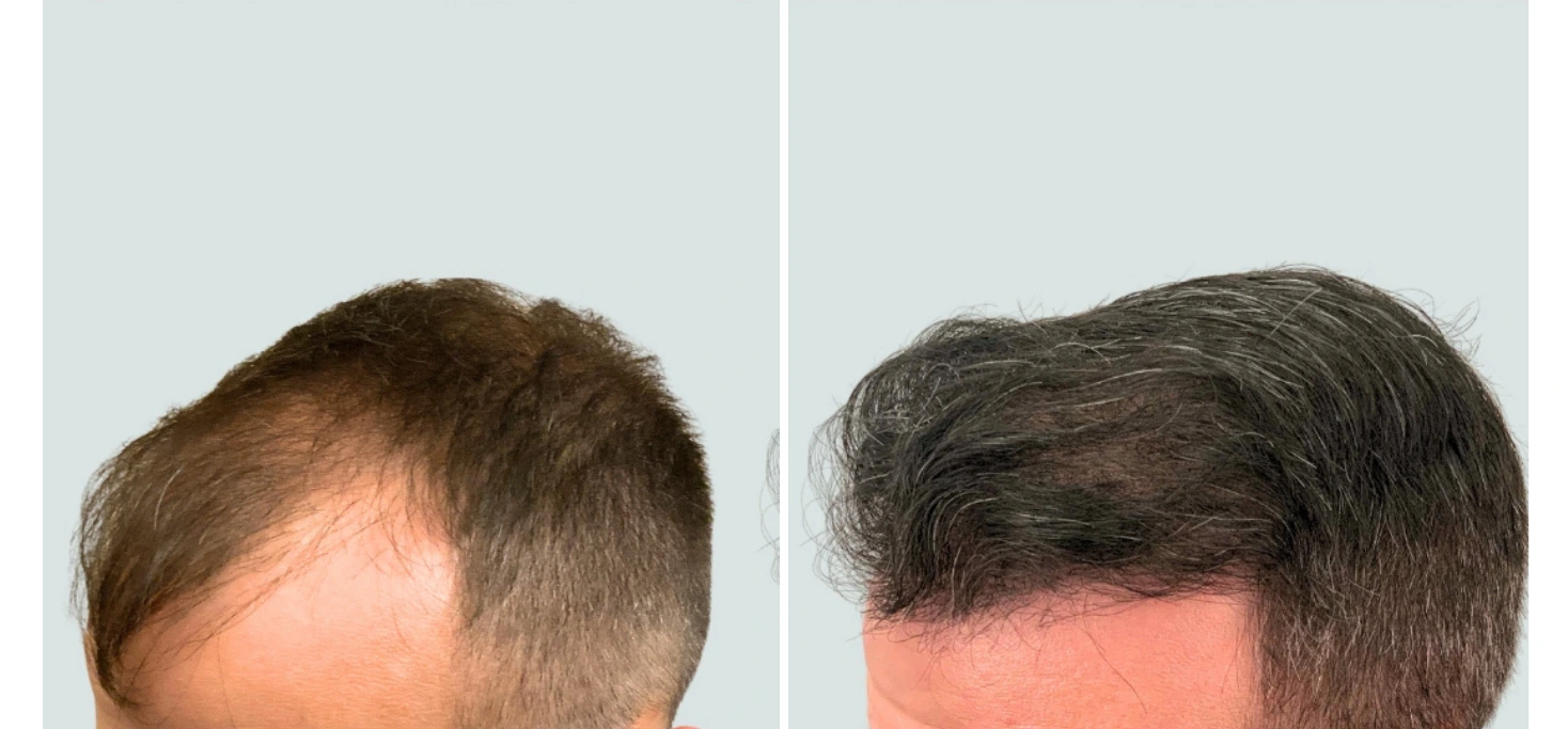 regeneris hair (1)