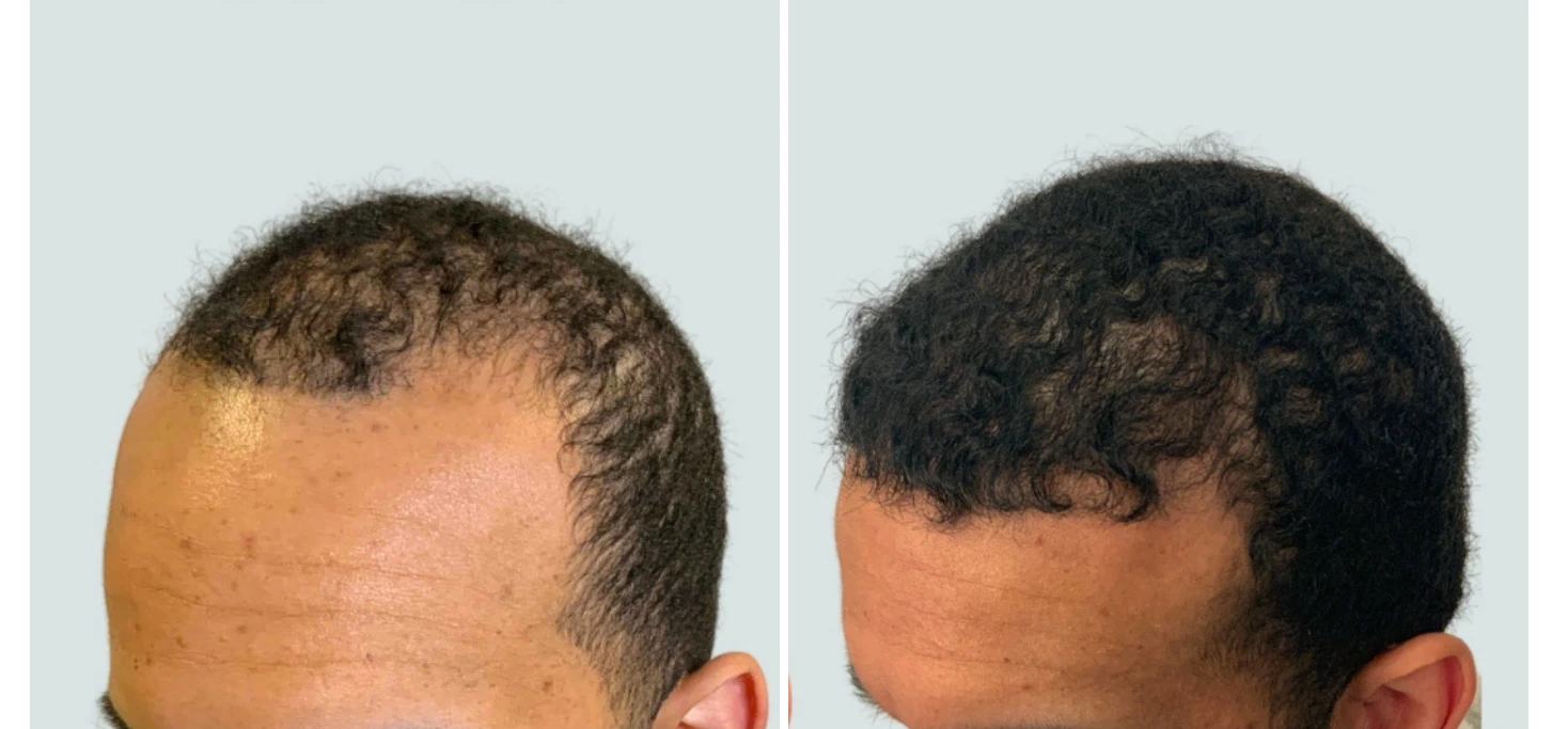 regeneris hair (2)