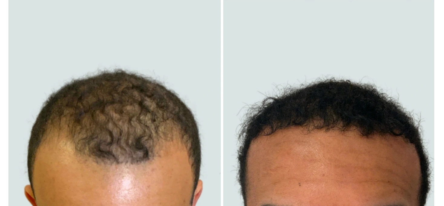 regeneris hair (3)