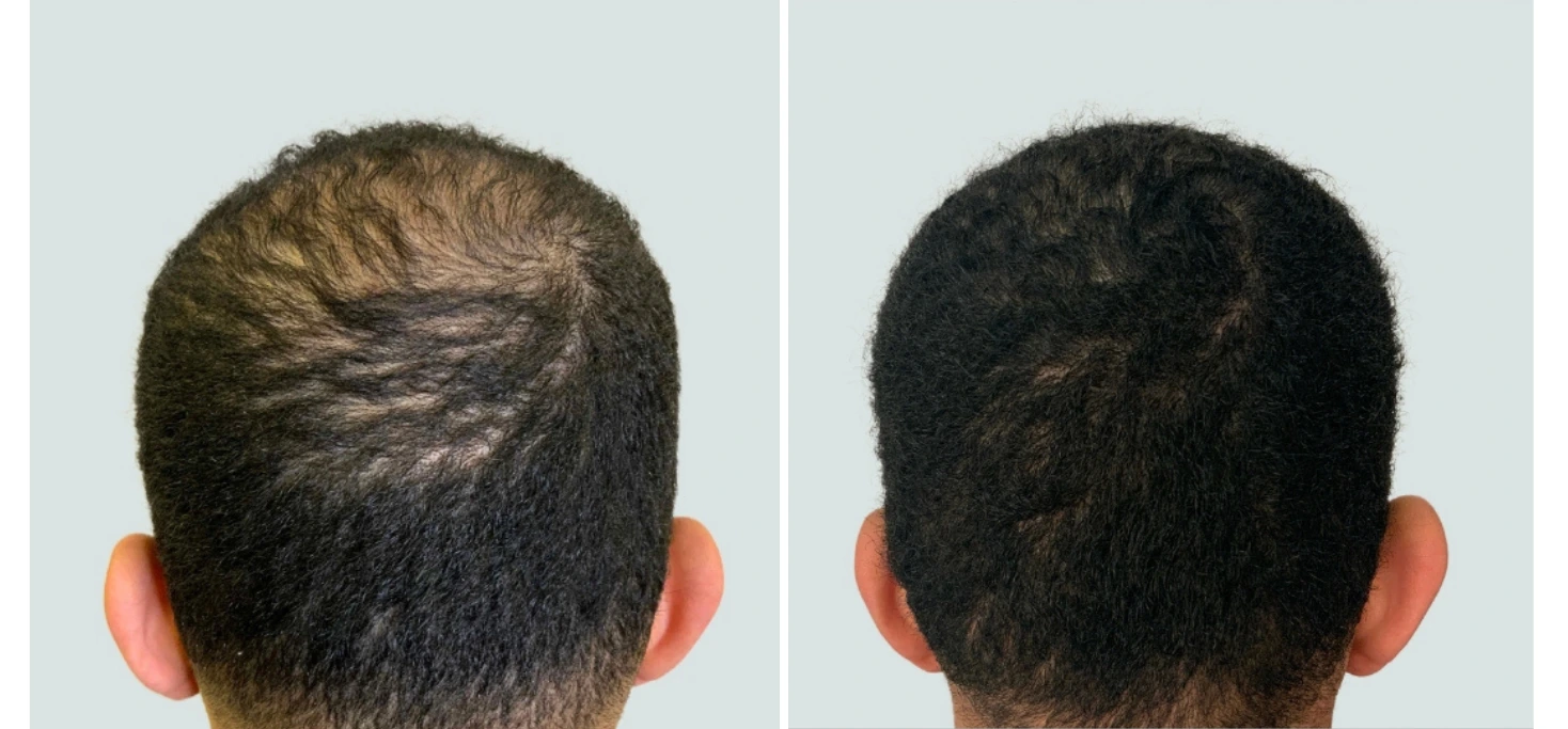 regeneris hair (4)