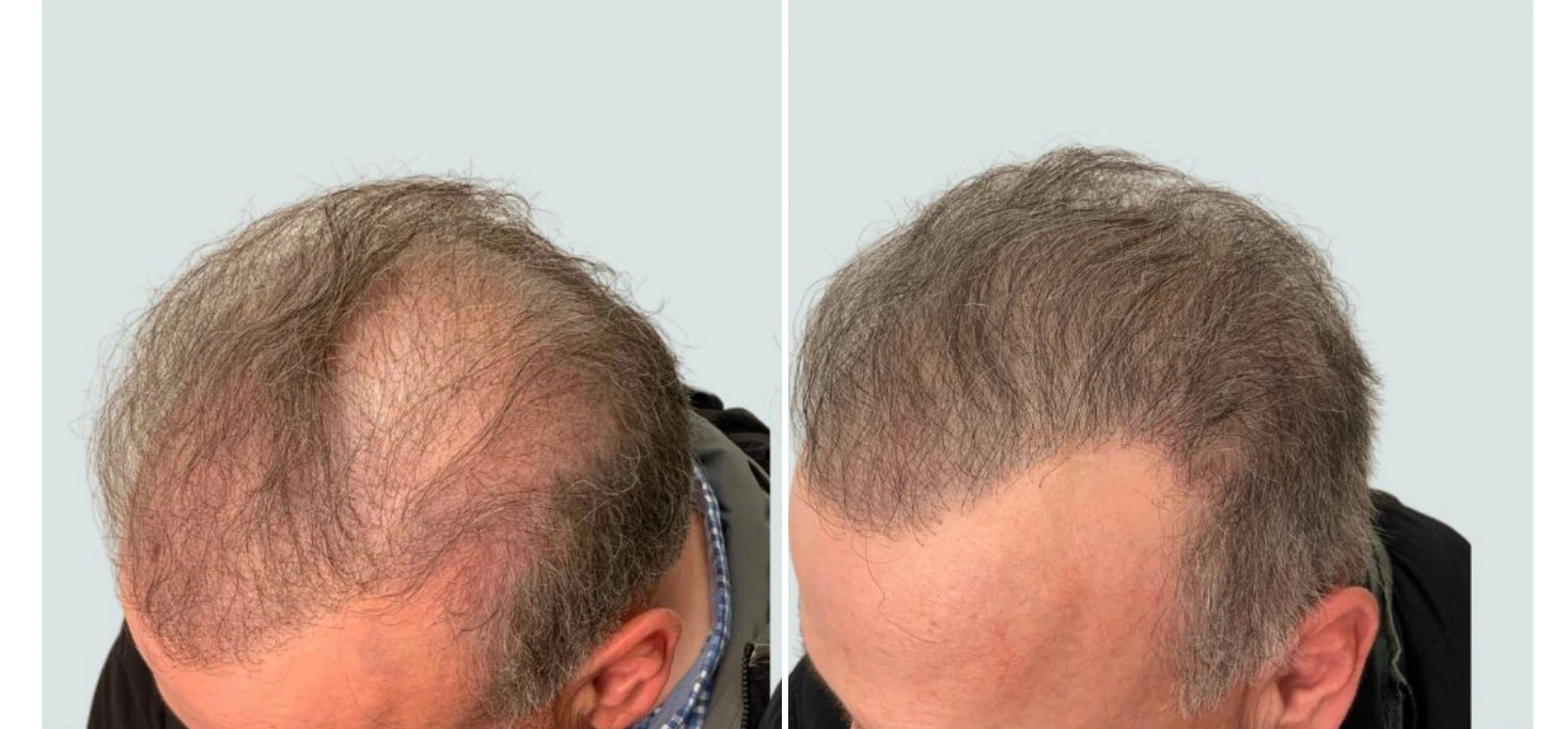 regeneris hair (9)