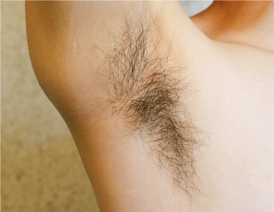Candidates for Armpit Hair Transplant Banner