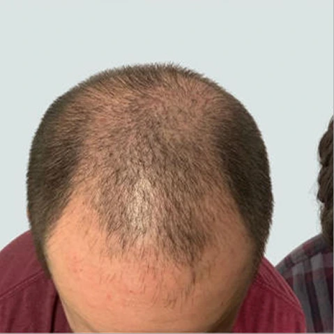 Hair Transplant Before & After - first slide - image (1)