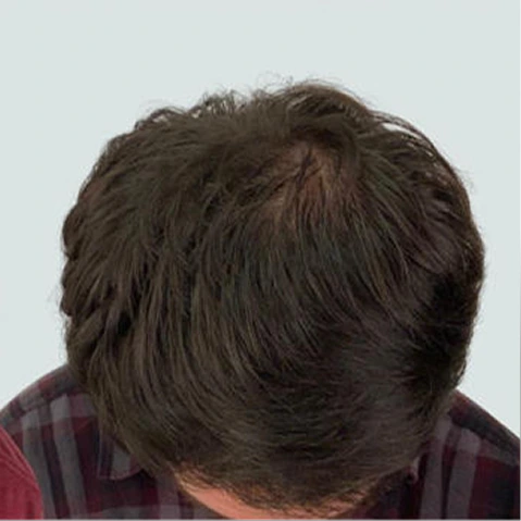Hair Transplant Before & After - first slide - image (2)
