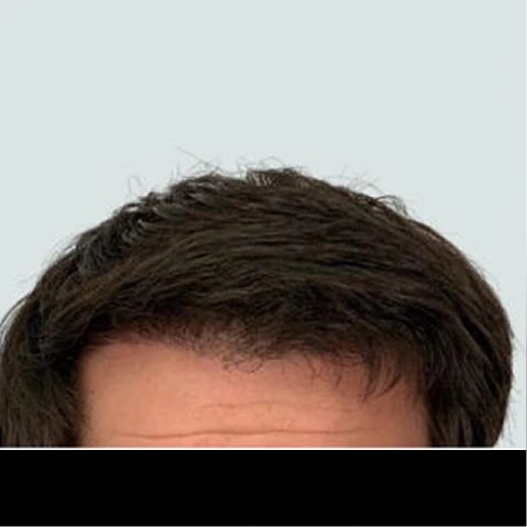 Hair Transplant Before & After - full - images (2)