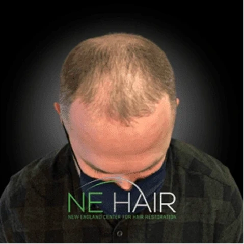 Hair Transplant Before & After - full - images (5)