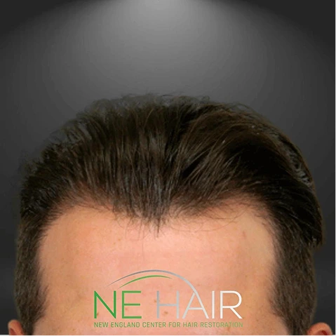 Hair Transplant Before & After - full - images (6)