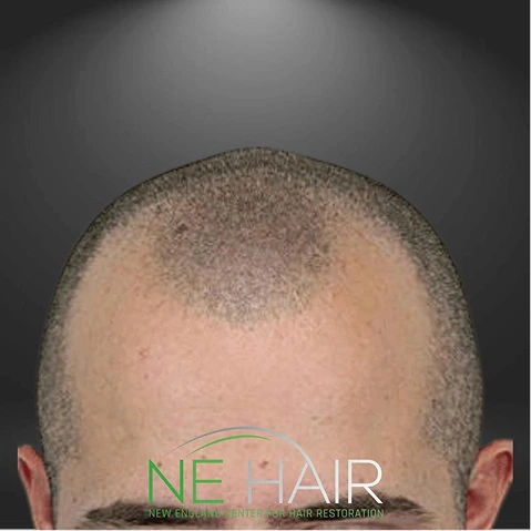 Hair Transplant Before & After - full - images (7)