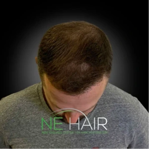 Hair Transplant Before & After