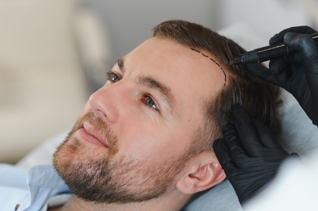 FUE vs FUT Hair Transplant: Which Technique Is Right for You? banner